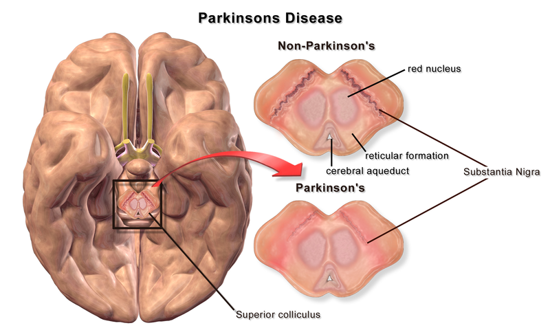 Overview of Parkinson's Disease symptoms